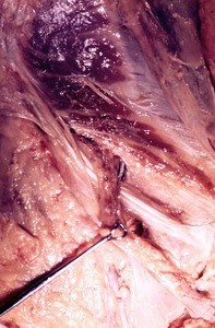 Natural color photograph of dissection of the inguinal region, anterior view, showing the right spermatic cord exiting the deep inguinal ring