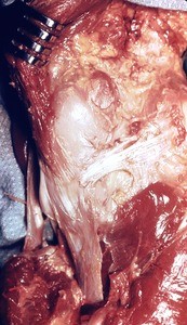 Natural color photograph of dissection of the right knee, medial view, with the vastus medialis retracted and the patellar ligament visible running from the patella to the bottom of the slide