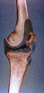 Illustration of articulation of left femur with left tibia & patella (knee joint, medial view); shown in blue are the joint cavity and synovial bursae: suprapatellar, prepatellar & infrapatellar