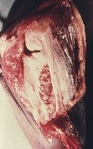 Natural color photograph of dissection of the elbow, posterior view