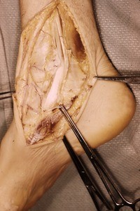 Natural color photograph of dissection of the right ankle, medial view, exposing the tibialis posterior t. and the flexor digitorum longus t