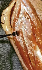 Natural color photograph of dissection of the forearm, showing muscles