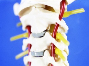 Color photograph of plastic model of articulated cervical vertebrae 2 through 5, the left vertebral artery's cervical nerve roots and sensory ganglia 2, 3 & 4, and cervical intervertebral discs 2, 3 & 4