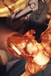 Natural color photograph of dissection of the ankle, showing articular surfaces