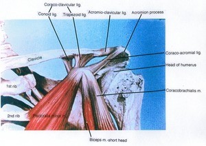 Illustration of the left shoulder, anterior view, showing the pectroalis minor and biceps muscles, bone structure, and ligaments