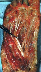 Natural color photograph of dissection of the plantar surface of the right foot