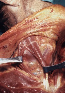 Natural color photograph of dissection of the right side of the neck, anterior view, showing the sternal and clavicular heads of the sternocleidomastoid muscle retracted from each other