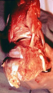 Natural color photograph of dissection of the right foot, posterolateral view, with the calcaneal tendon cut