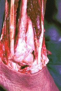 Natural color photograph of dissection of the right ankle, lateral view