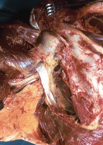 Natural color photograph of dissection of the left shoulder, posterior view, with the deltoid and rotator cuff muscles reflected to expose the head and surgical neck of the humerus