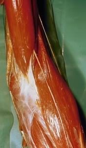 Natural color photograph of dissection of the left cubital fossa, anterior view