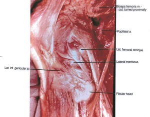 Natural color photograph of left knee, lateral view, showing muscle, arteries, menisci and bone