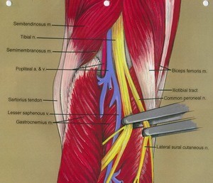 Illustration of right knee, posterior view, showing muscles, tendon, artery, nerves and vein with common peroneal and tibial nerves retracted