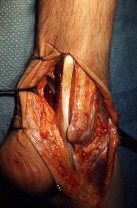 Natural color photograph of dissection of the right ankle, lateral view