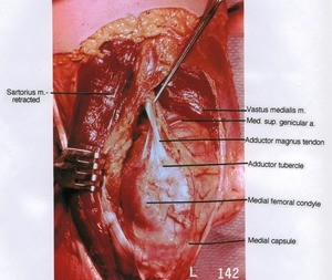 Natural color photograph of left knee, medial view, showing muscles, artery, tendon, bones and medial capsule