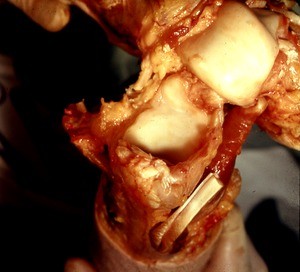 Natural color photograph of dissection of the ankle, showing articular surfaces