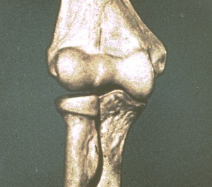 Illustration of articulated dry bones of right elbow, anterior surface