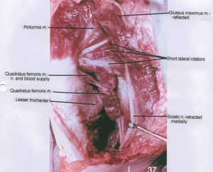 Natural color photograph of dissection of muscles of the left gluteal region, posterior view, with the gluteus maximus muscle cut and reflected