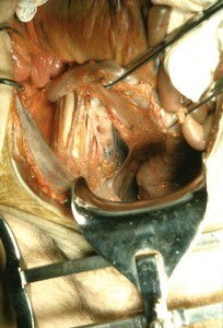 Natural color photograph of dissection of the right lower abdominal and pelvic cavity, anterior view, with the peritoneum incised and retracted to expose the nerves and vessels lying on top of the right psoas muscle