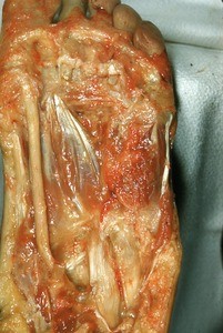 Natural color photograph of dissection of the plantar surface of the left foot, showing the flexor hallucis longus tendon and associated structures