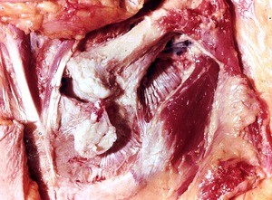 Natural color photograph of dissection of the thoracic wall, overlying the clavicle, which has been disarticulated from the sternum