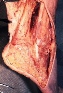 Natural color photograph of dissection of the right ankle, lateral view