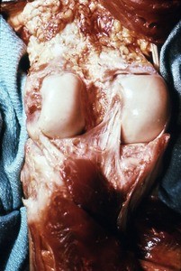 Natural color photograph of dissection of the left knee, posterior view, showing the posterior cruciate ligament