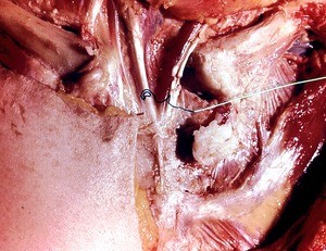 Natural color photograph of dissection of the thoracic wall, with a string tied aroung the right sternocleidomastoid m