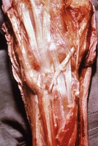 Natural color photograph of dissection of the left hand, posterior view, showing extensor tendons