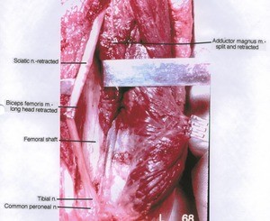 Natural color photograph of left lower thigh, posterior view, showing muscles, nerves and bone with the sciatic nerve, bicep femoris and adductor magnus retracted