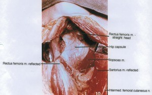 Natural color photograph of dissection of the right hip, anterior view, showing the hip capsule with the rectus femoris muscle and sartorius muscle reflected