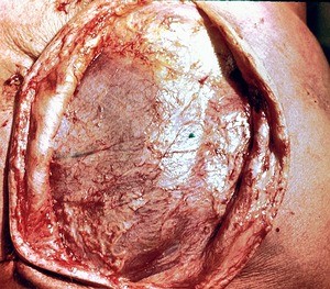 Natural color photograph of dissection of the left back, posterior view, with the skin incised and retracted