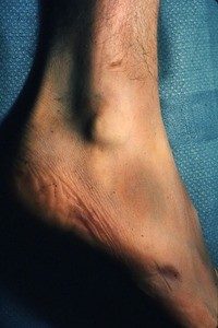 Natural color photograph of the right ankle, lateral view