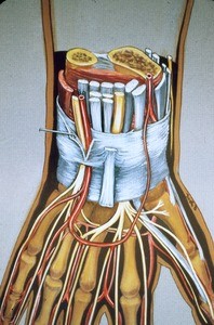 Illustration of distal left forearm (transected), flexor retinaculum, radial and ulnar arteries with superficial arch and common digital arteries, ulnar and median nerves and bones of fingers