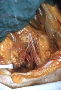 Natural color photograph of dissection of the abdomen, anterior view