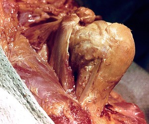 Natural color photograph of dissection of the left shoulder, anterior view, with the deltoid muscle reflected to expose the attachment of the short head of the biceps brachii, coracobrachialis, and pectoralis minor muscles to the coracoid process