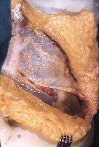 Natural color photograph of right inguinal region, with external oblique muscle, internal oblique muscle and fascial layers plus external abdominal fat