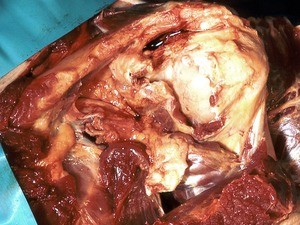 Natural color photograph of dissection of the left shoulder, anterosuperior view, with the fibrous capsule of the glenohumeral joint cut to expose the head of the humerus