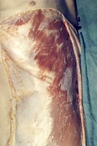 Natural color photograph of dissection of the left abdominal wall, anterior view