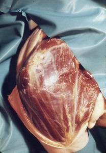 Natural color photograph of dissection of the right shoulder, anterolateral view, with the skin reflected to expose the deltoid muscle