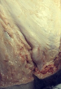 Natural color photograph of dissection of the inguinal region, anterior view, showing intercrural fibers overlying the spermatic cord