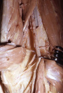 Natural color photograph of dissection of the popliteal fossa, showing the popliteal artery, with the popliteal vein and tibial nerve cut