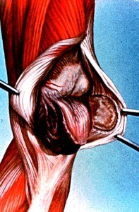 Illustration of surgical exposure of sub-patellar area of left knee, medial-anterior view