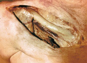 Natural color photograph of dissection of the right upper quadrant of the thorax, anterior view, with the skin over the clavicle incised and retracted to expose bone and muscle