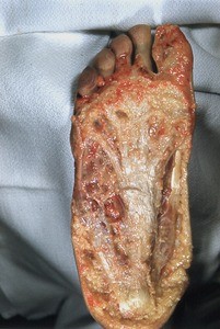 Natural color photograph of dissection of the plantar surface of the right foot