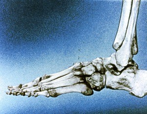 Illustration of bones of left foot and ankle, lateral view