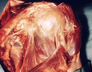 Natural color photograph of dissection of the left shoulder, anterosuperior view, showing bones, muscles, tendons, and nerves