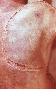 Natural color photograph of dissection of the left shoulder and back, posterior view, showing an incision in the skin prior to reflecting the skin