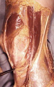 Natural color photograph of dissection of the right knee, anteromedial view, showing muscles, tendons and vasculature