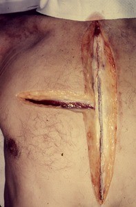 Natural color photograph of the thorax, anterior view, showing two perpendicular incisions made in preparation to retract the skin and superficial muscle of the upper right quadrant of the thorax